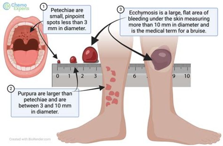 Are ecchymosis and bruise the same?