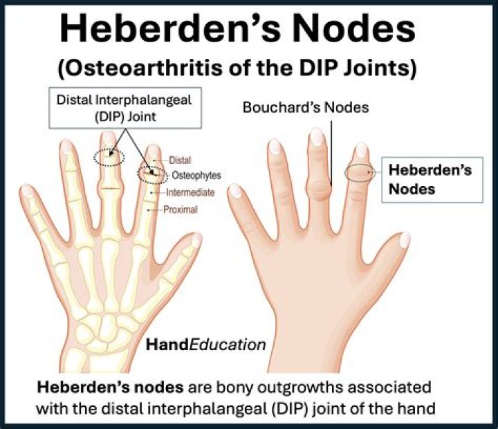 Are heberden's nodes painful?