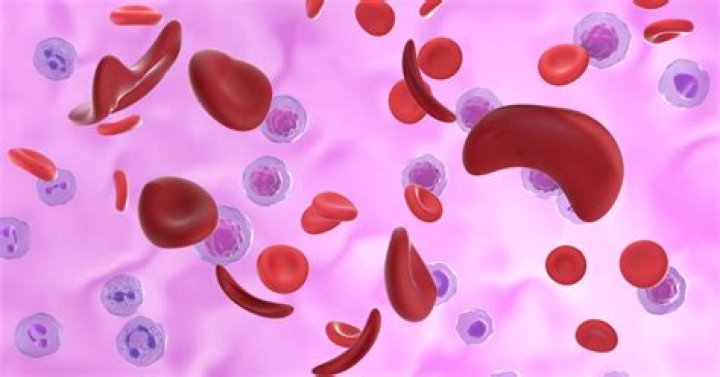 Are sickle cell malaria?