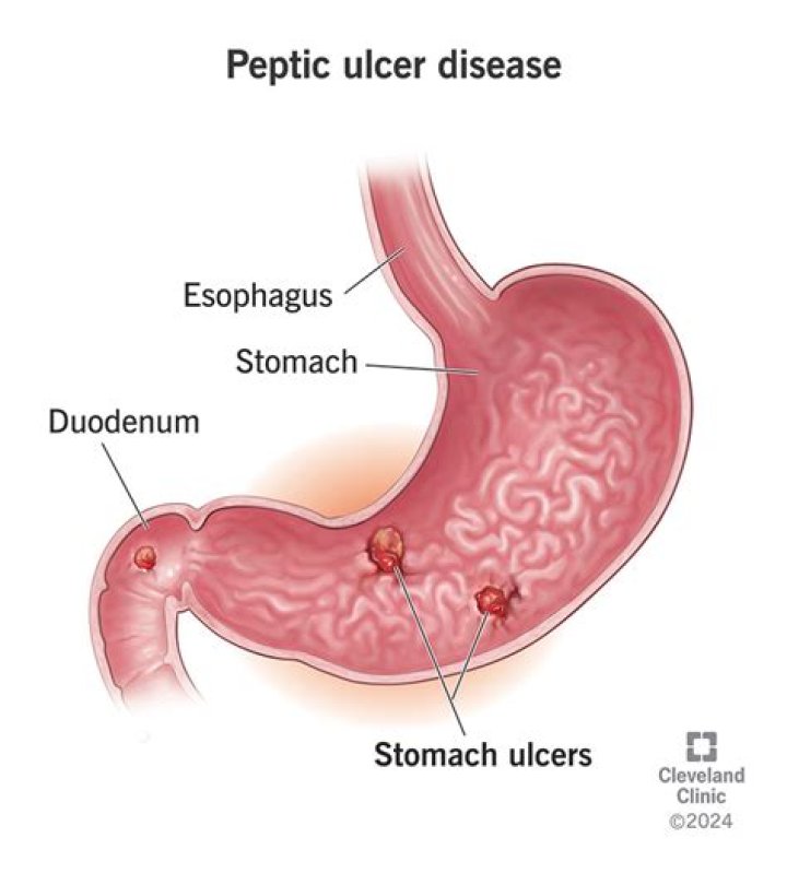 Are stomach ulcers painful?