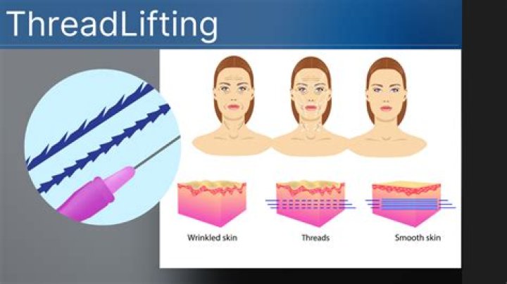 Are thread lifts safe?