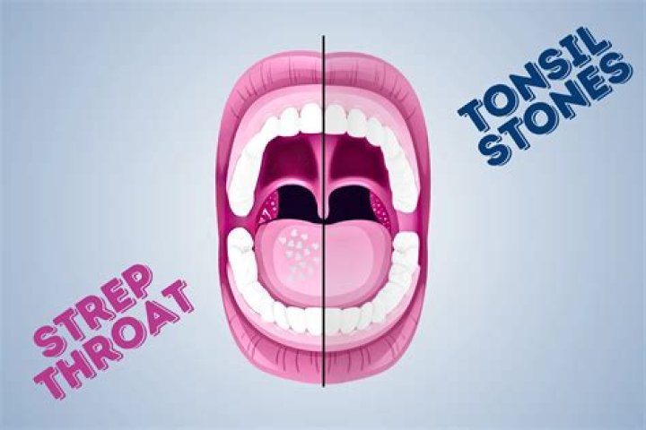Are tonsils swollen with strep throat?