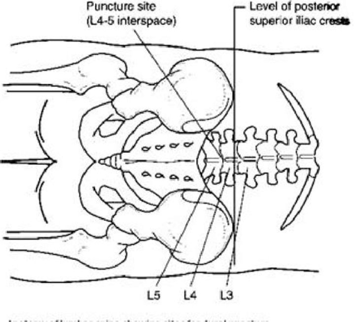 At level of iliac crest?