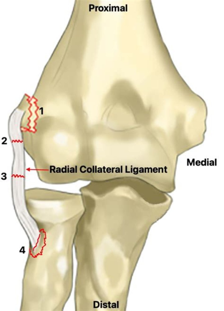 By lateral collateral ligament?