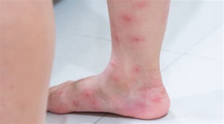 Can carpenter ants bite?