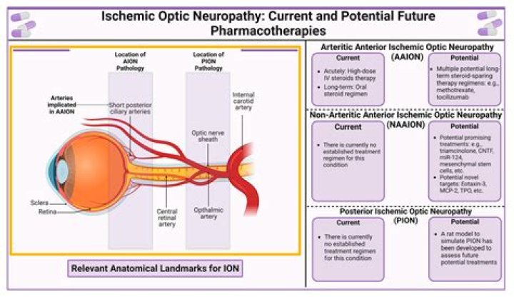 Can cialis cause naion?
