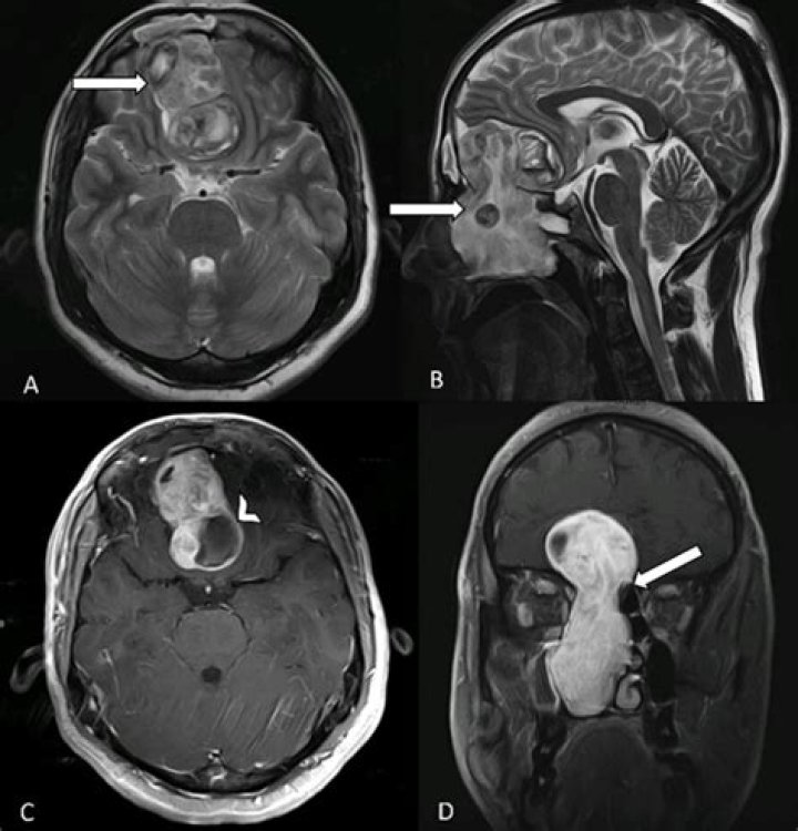 Can esthesioneuroblastoma be treated?