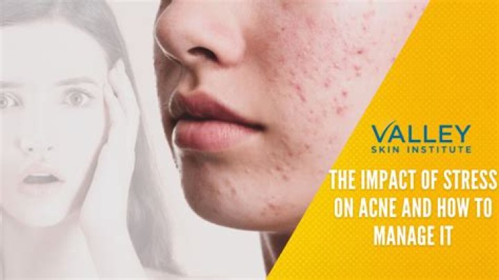 Can haldi cause acne?
