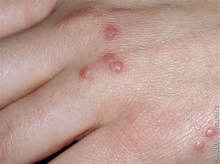 Can hives look like pimples?