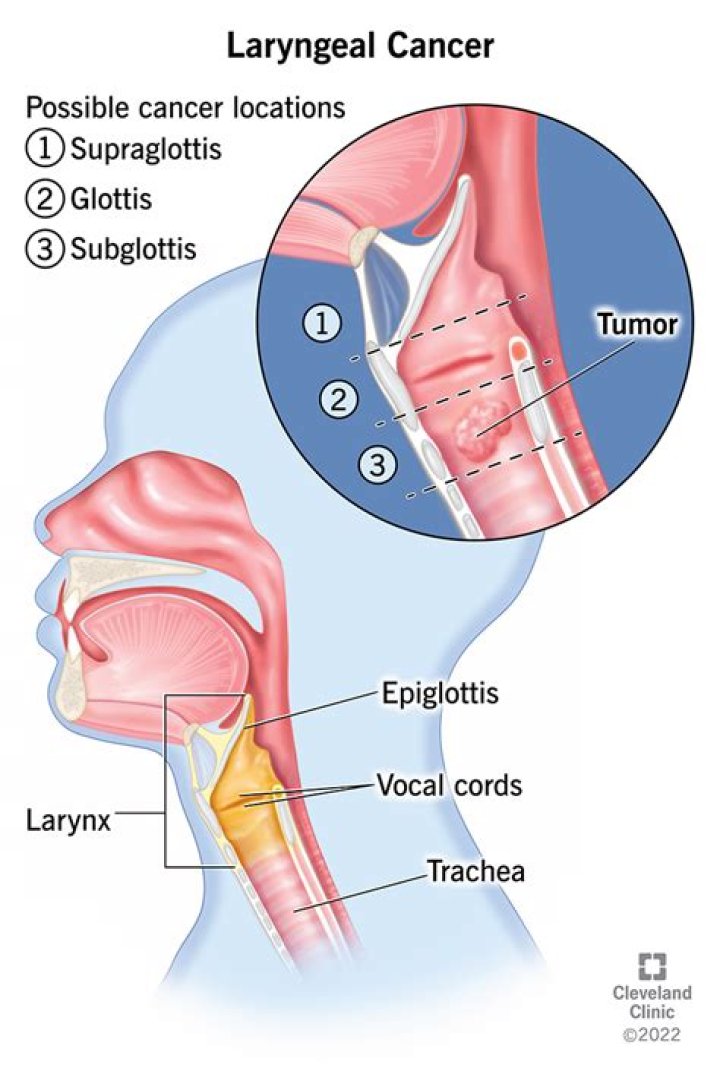 Can laryngeal cancer kill you?