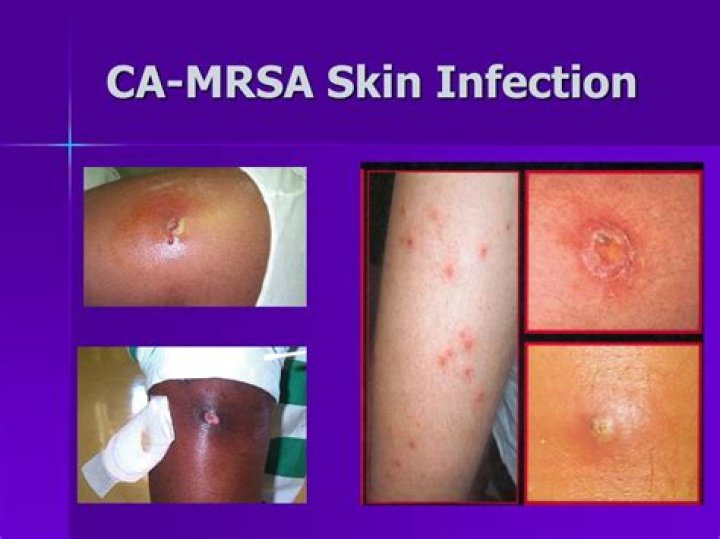 Can mrsa go away on its own?