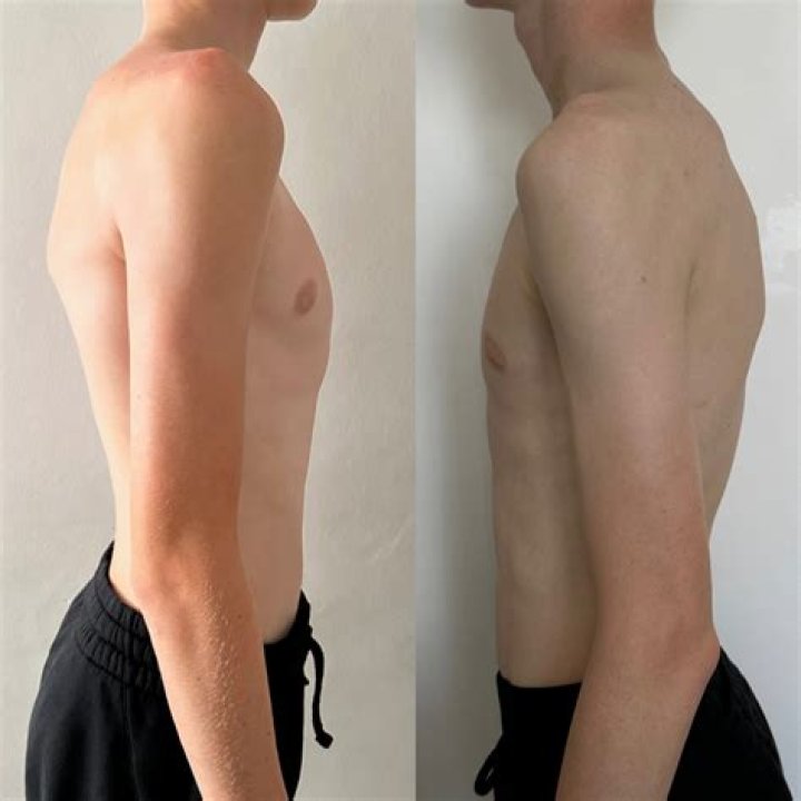 Can pectus carinatum be fixed in adults?