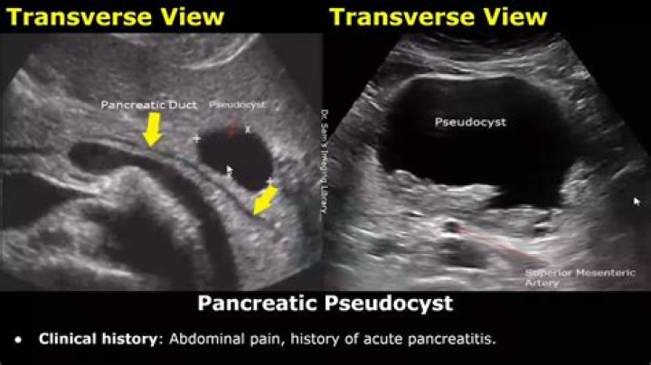 Can pseudocyst go away?