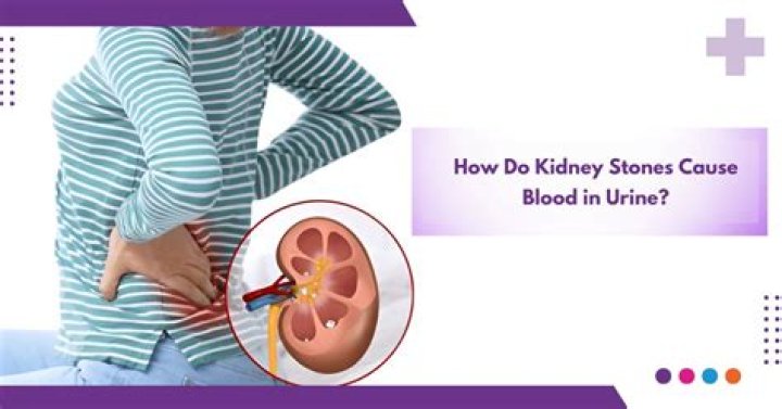 Can stones cause kidney failure?