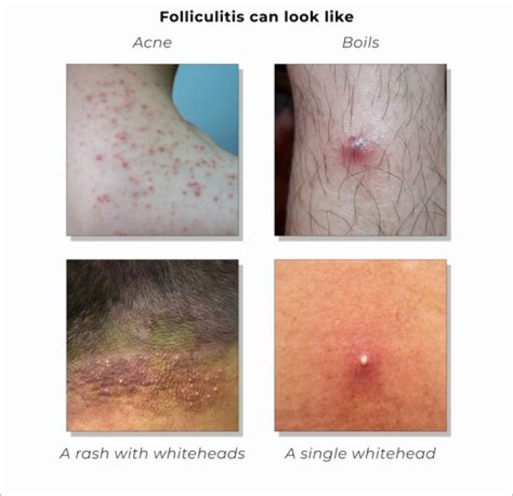 Can stress cause folliculitis?