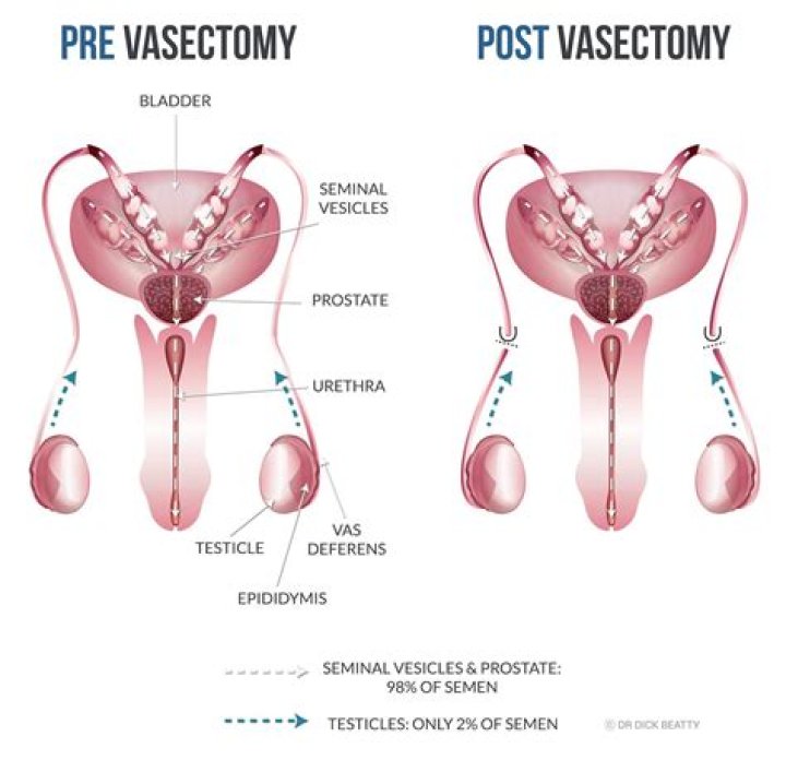 Can vasectomies reverse themselves?