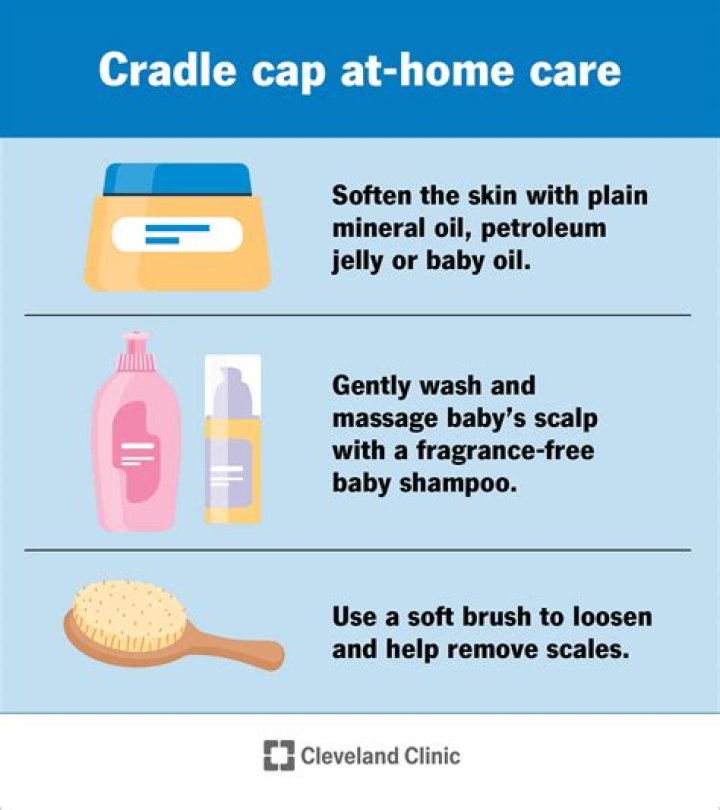 Can you put lotion on cradle cap?
