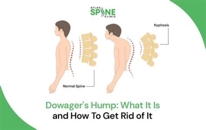 Can you reverse a dowager's hump?