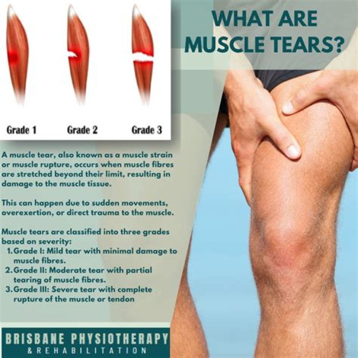 Can you tear a muscle by overstretching?