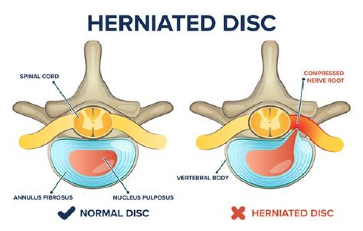 Could a herniated disc cause dizziness?