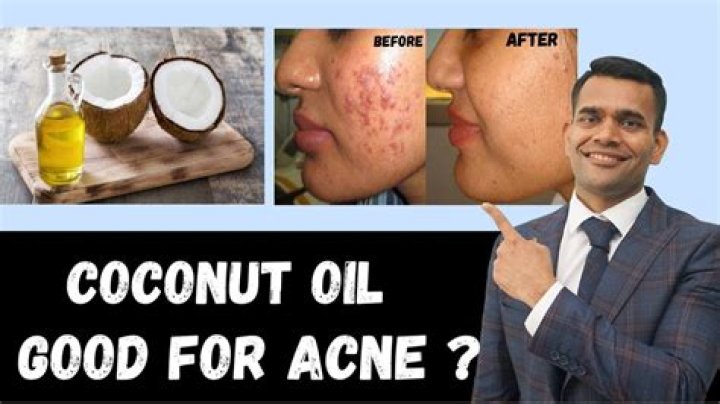 Could coconut oil cause acne?