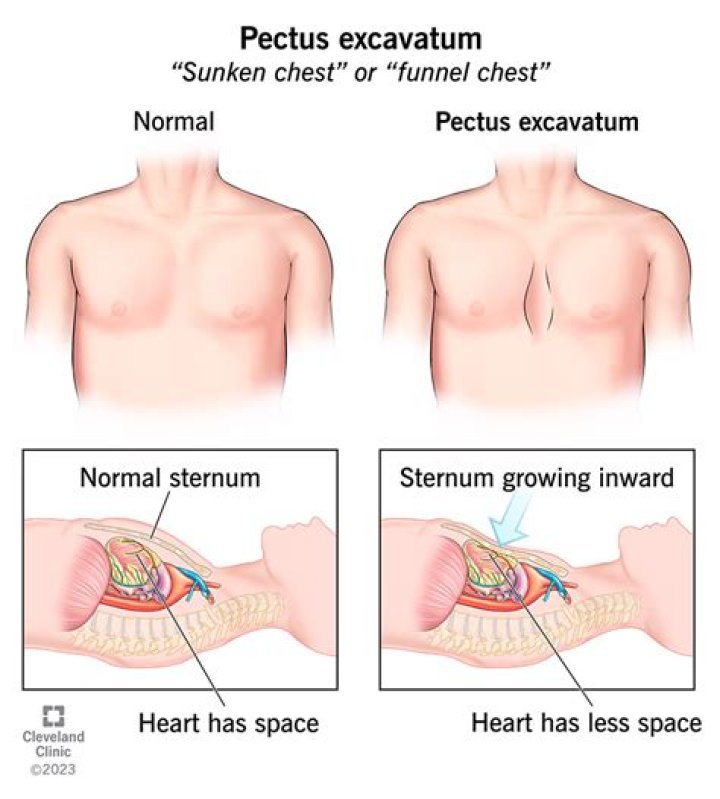 Could pectus excavatum kill you?