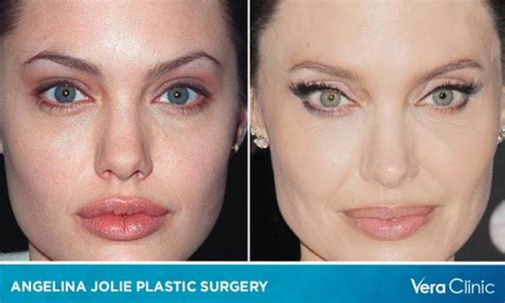 Did Angelina Jolie Get Plastic Surgery? What She’s Said and Her Transformation Over the Years