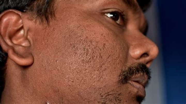 Do atrophic acne scars go away?