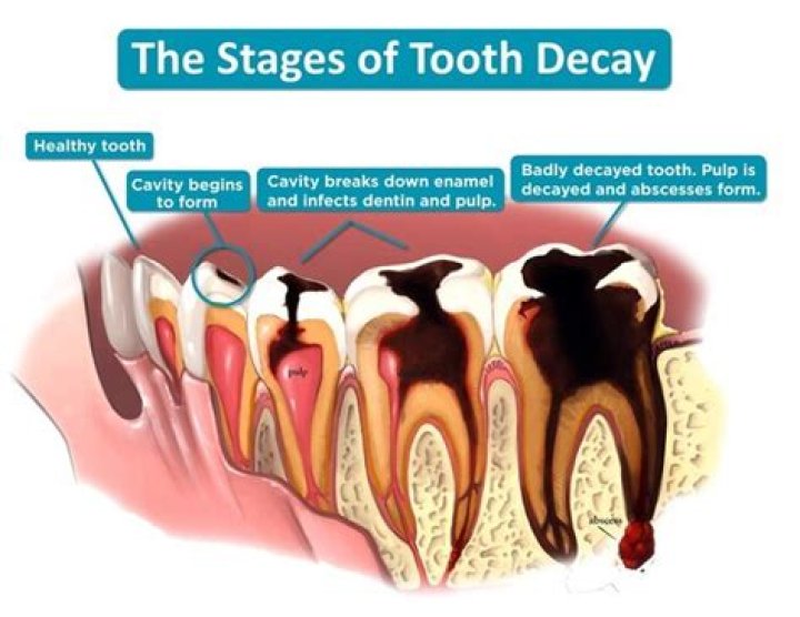 Do decaying teeth hurt?
