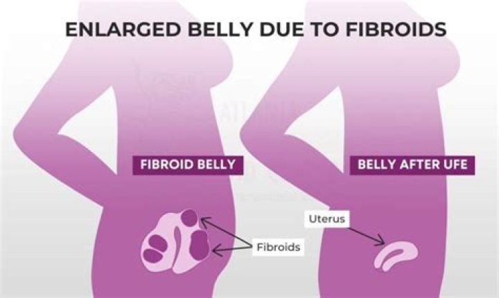 Do fibroid tumors bleed?