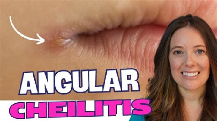 Do i need to see a doctor for angular cheilitis?