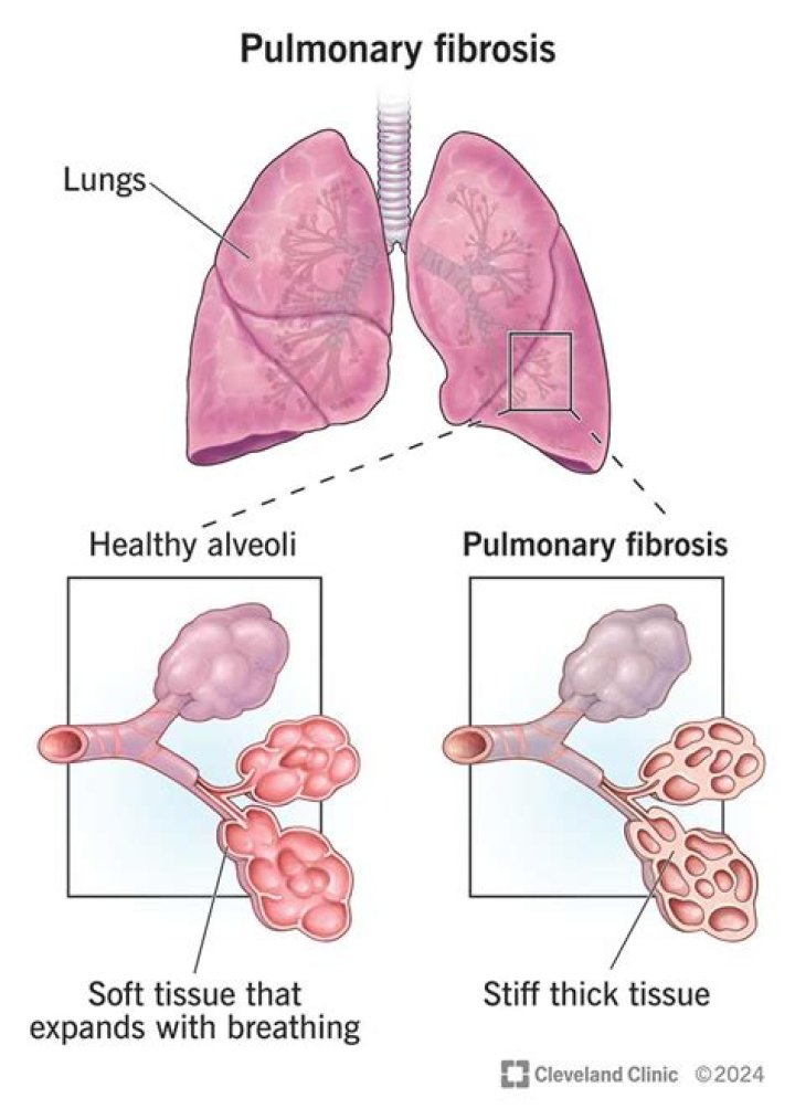 Do inhalers help pulmonary fibrosis?