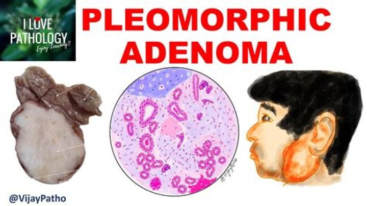 Do pleomorphic adenoma go away?