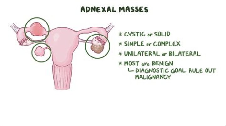 Does adnexal mass mean cancer?