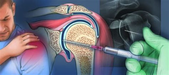 Does an arthrogram hurt?