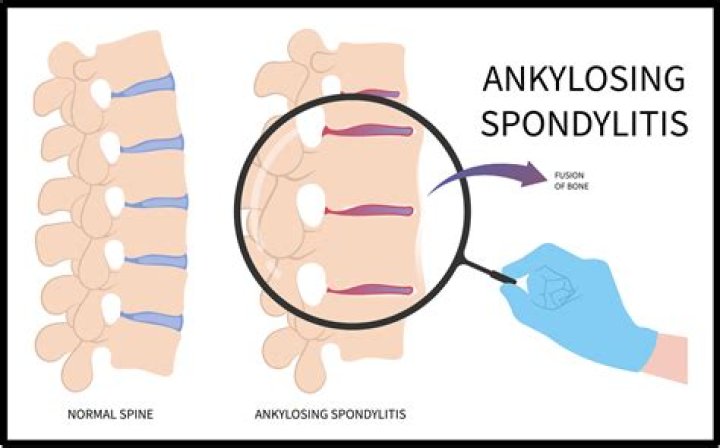 Does ankylosing spondylitis show up in blood test?
