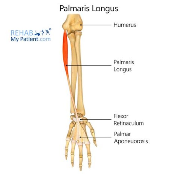 Does everyone have a palmaris longus muscle?