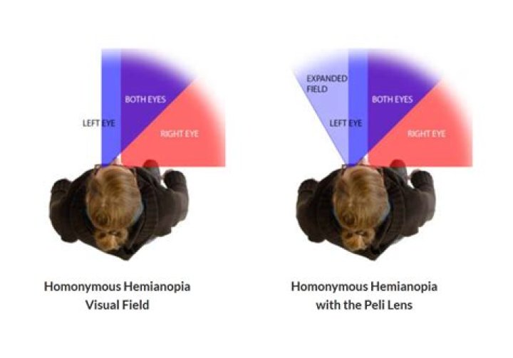Does homonymous hemianopia improve?