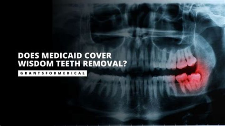 Does medicaid cover wisdom teeth removal?