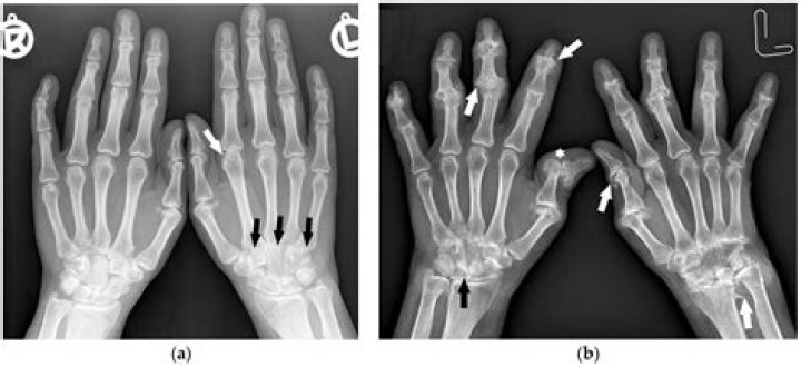 Does synovitis show on x ray?
