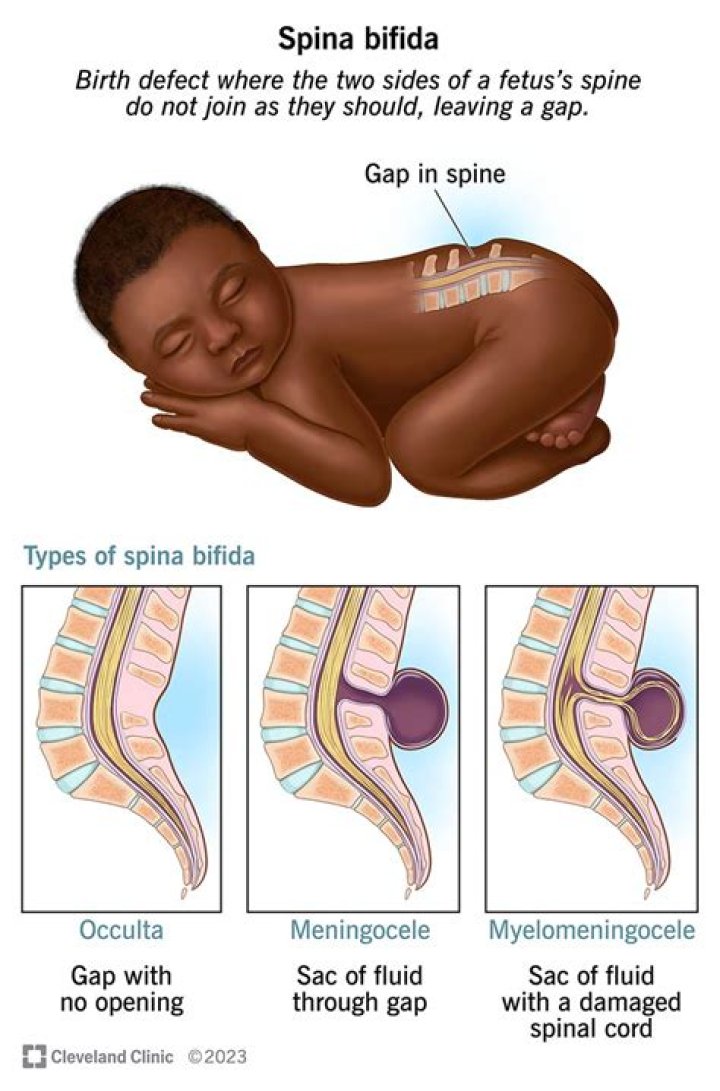 Has spina bifida decreased?