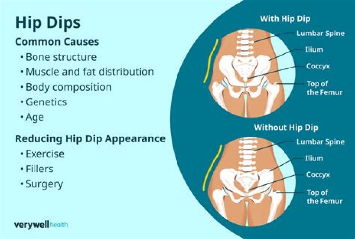 How are hip dips causes?