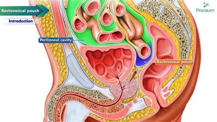 How is rectovesical pouch formed?