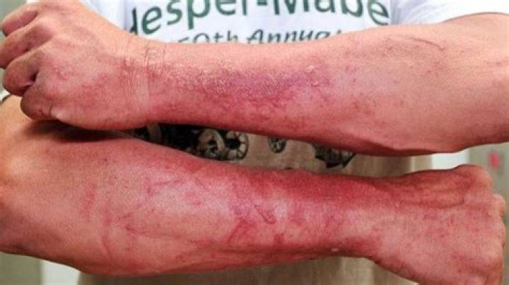 How long does it take for wild parsnip rash to go away?