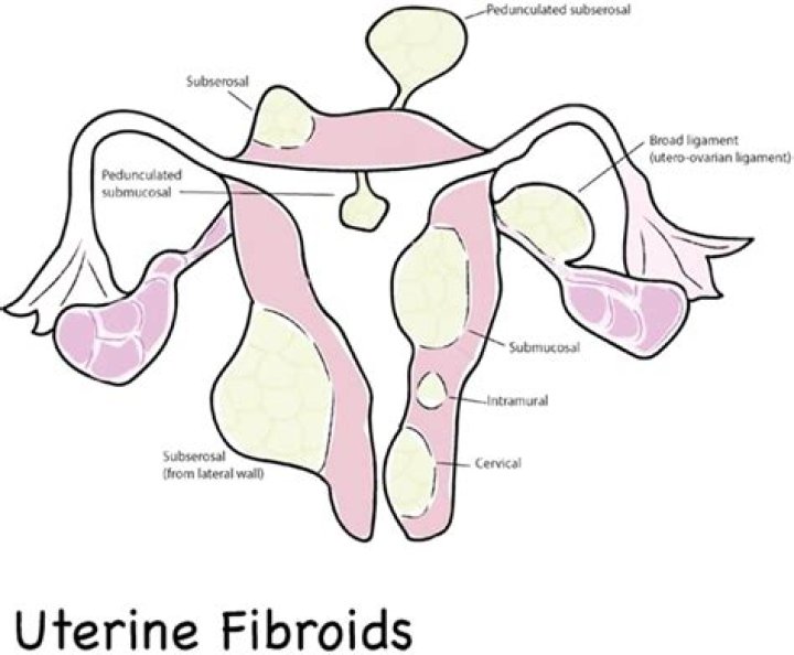 Is a fibroid an adnexal mass?