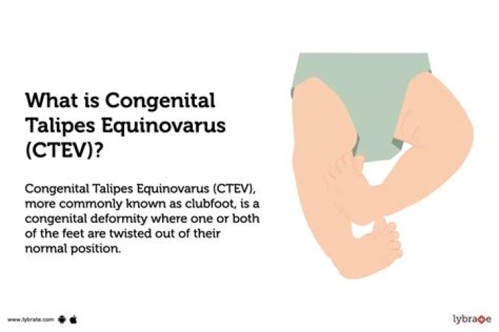 Is congenital talipes equinovarus?