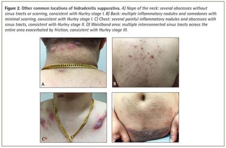 Is hidradenitis suppurativa contagious?