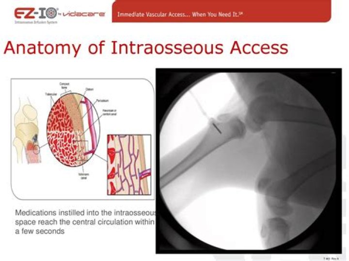Is intraosseous a word?