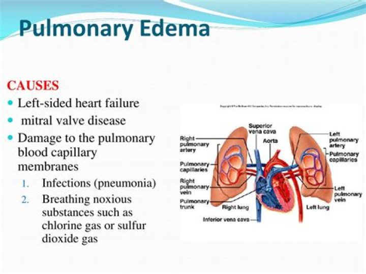 Is pulmonary oedema heart failure?