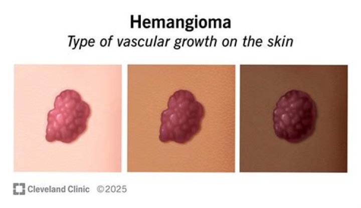 Is timolol used for hemangiomas?